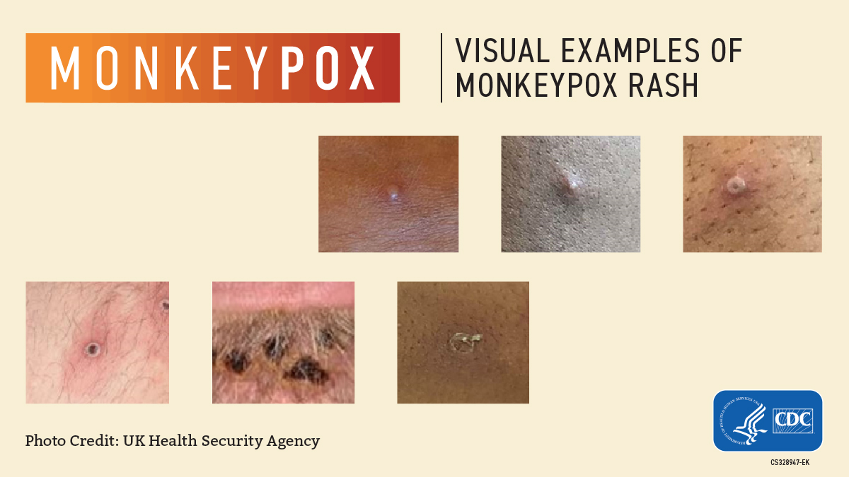 How does monkeypox start? Plus, 5 pictures to show how the bumps progress